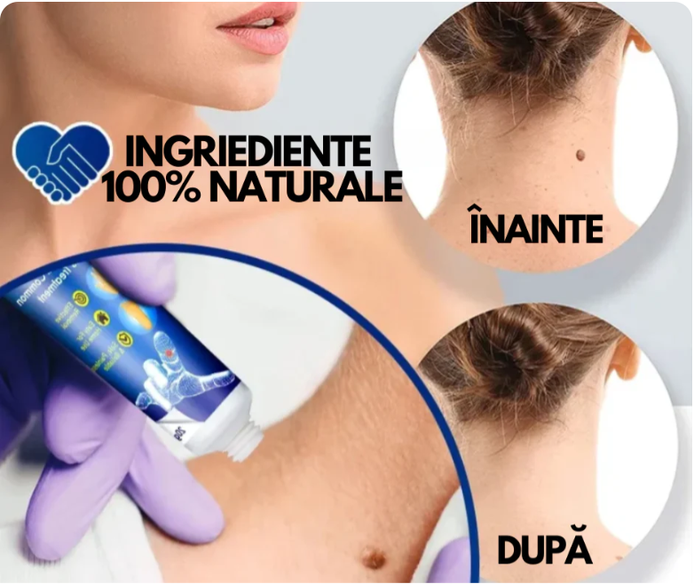 WartRemover - Crema Anti Negi si Bătături